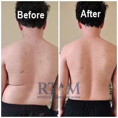 Before After Skoliosis Kasus 1